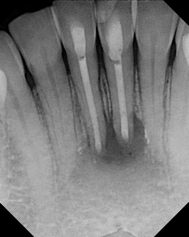 The Endo Blog Success with endodontic surgery (apicoectomy)