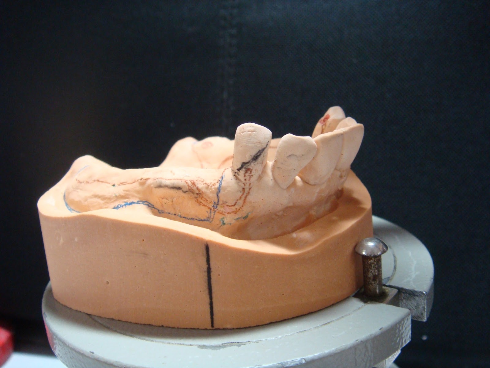 Step by step Guide for Understanding the Prosthodontics A step by step