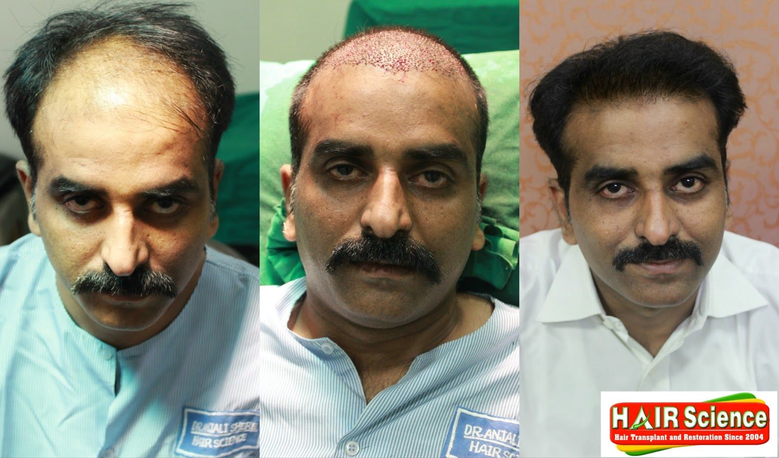 Hair Transplant Expert India: Hair Transplant Results in Mumbai,Pune and  kolhapur