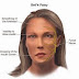 Best Ways To Cure Facial Paralysis
