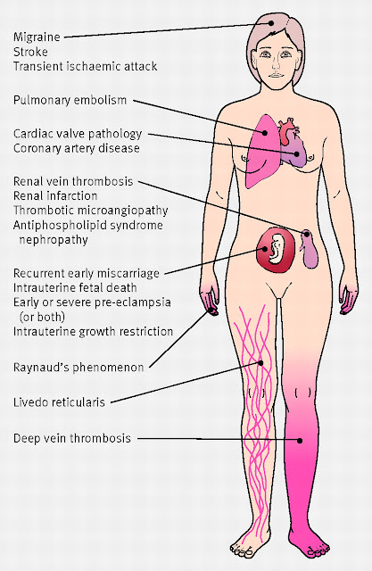 Antiphospholipid syndrome-signs