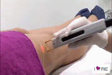 DEPILACION LASER depilacion laser: