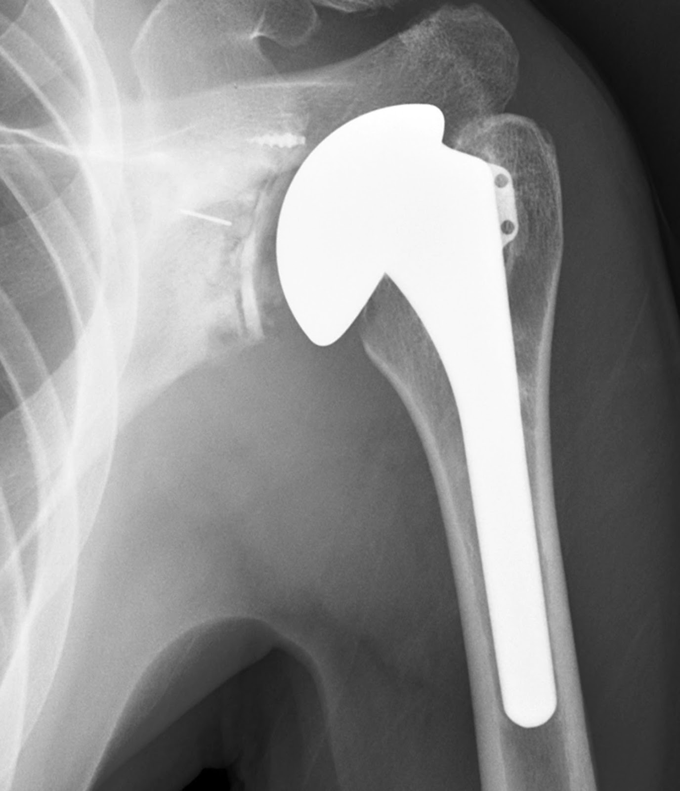 Shoulder Arthritis / Rotator Cuff Tears causes of shoulder pain Total