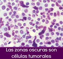 mastocitosis mastocitosis