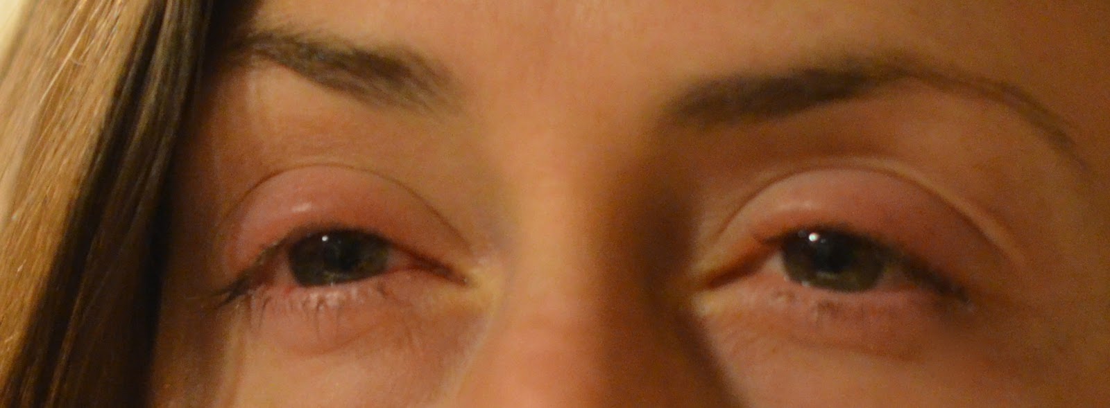 eyes after LASIK