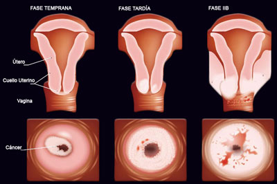 LESIONES EN EL CUELLO UTERINO lesiones en el cuello uterino: