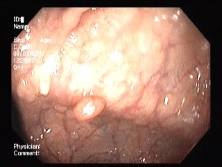 Lap Surgeon: Familial Adenomatous Polyposis