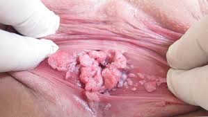 obat kutil kelamin buat sendiri