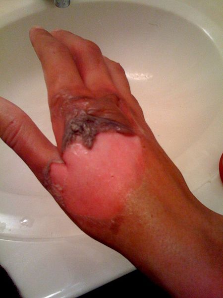Burn Injury Photos