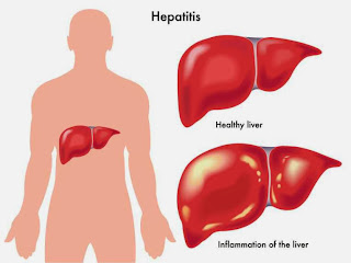 Obat Herbal Hepatitis Paling Mujarab
