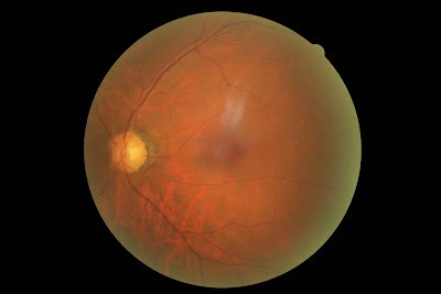 left retina