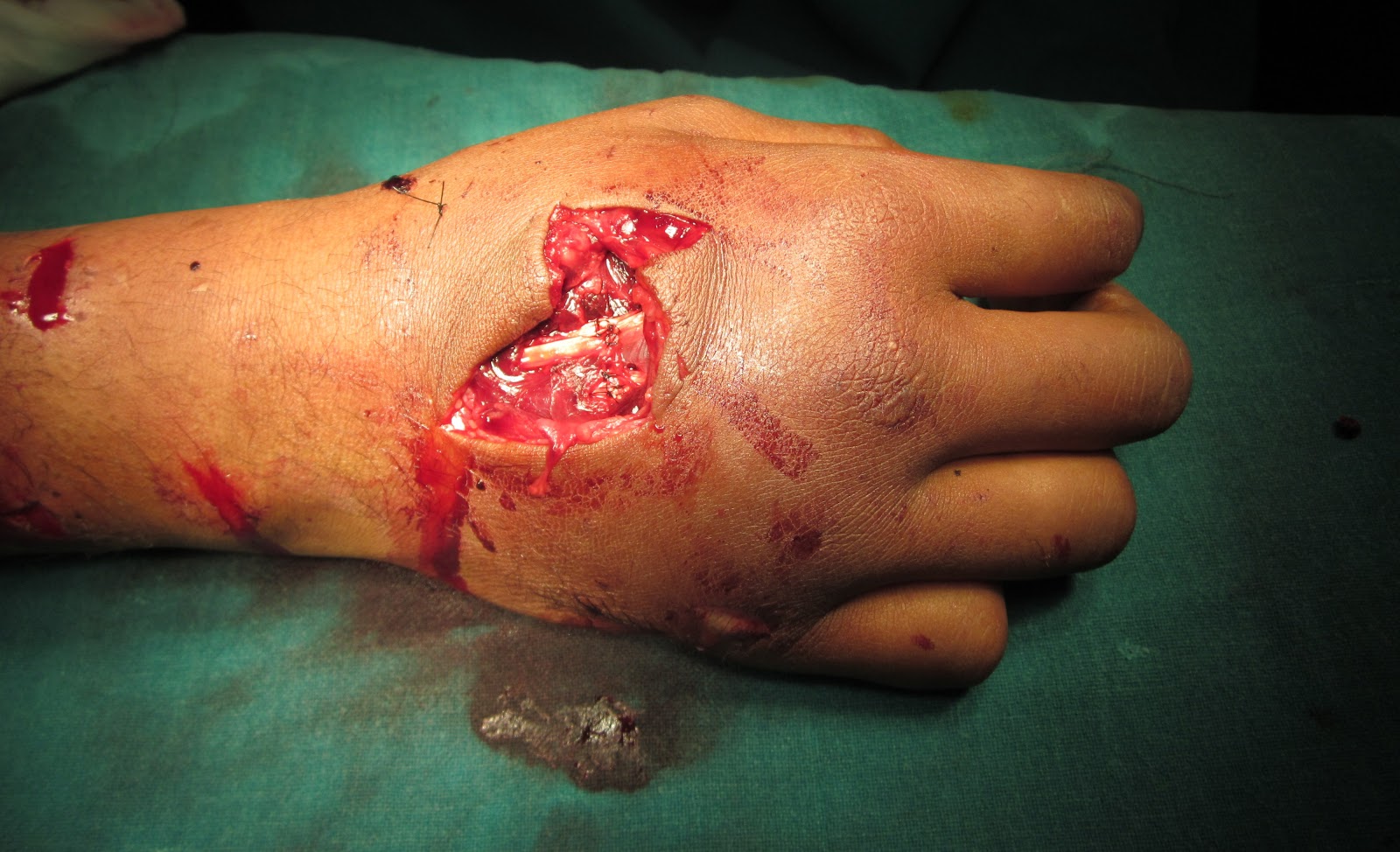 A Cut Hand
