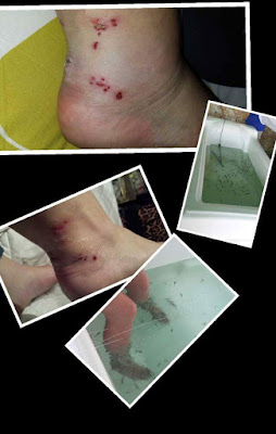Mrsa fish pedicure