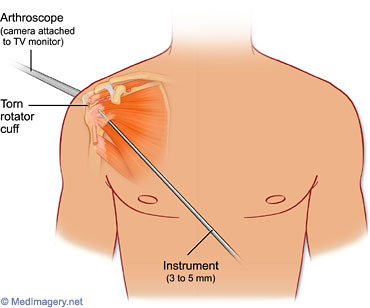 Steroid injection after rotator cuff surgery