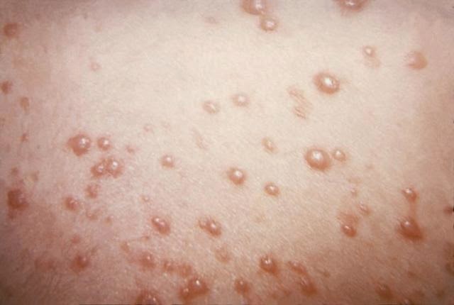 Complete Understanding of Genital Herpes in Men