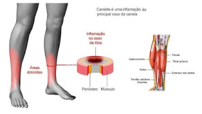 Patologias relacionadas à inflamação da Tíbia (Tibialgia)