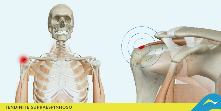 Tratamento de dores e doenças articulares