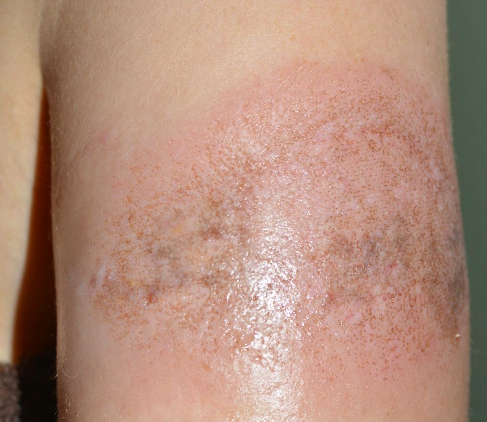 tattoo removal using white ink natural tattoo removal reviews tattoo removal using white ink natural tattoo removal reviews