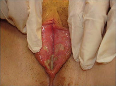 young perky xxx pics mole on vulva