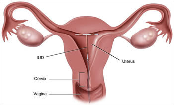 DIU dispositivo intrauterino posicionado no utero