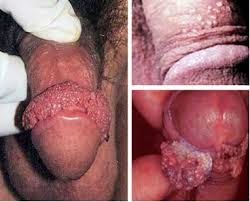Kutil Kelamin Di Penis Kutil Kelamin Di Penis