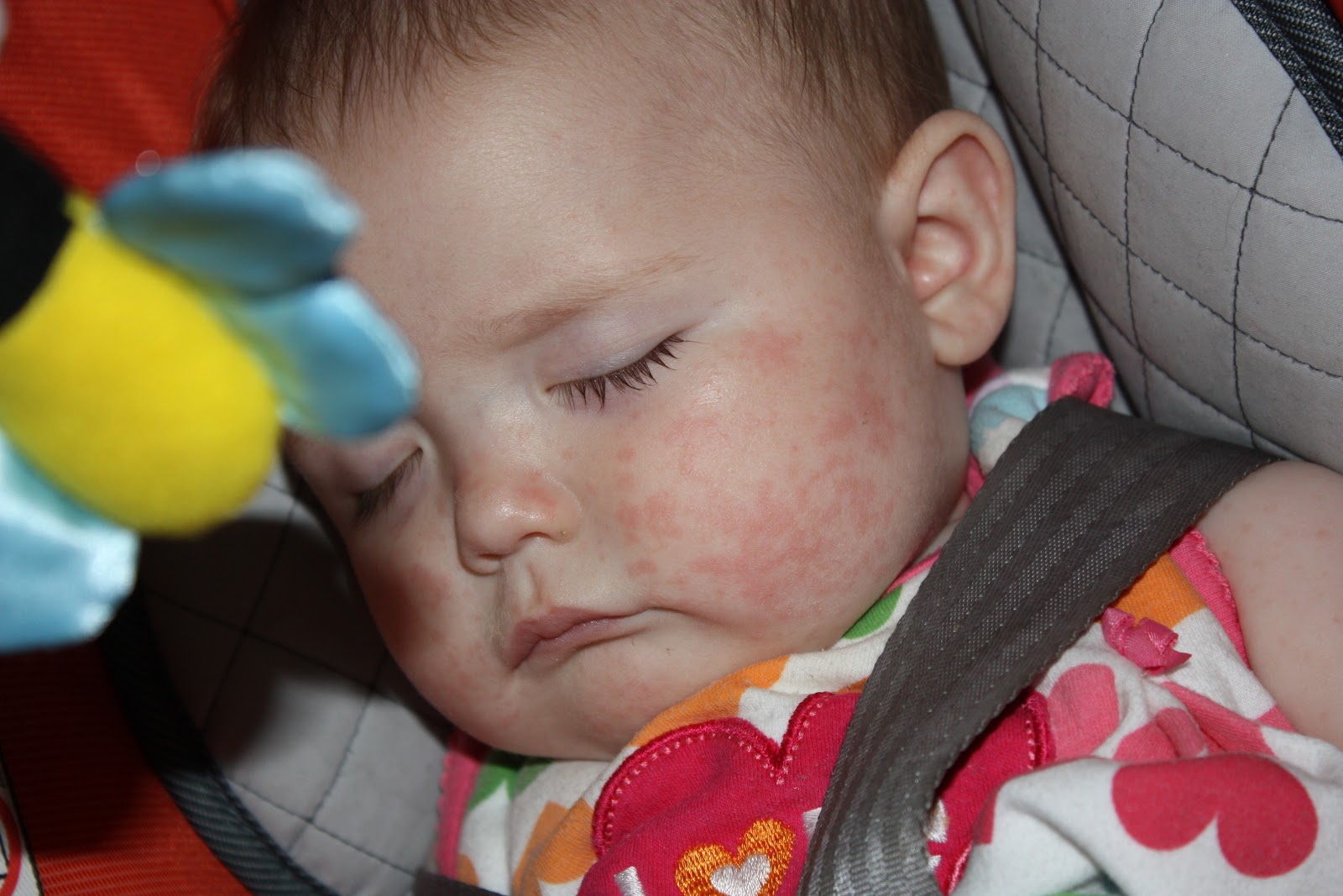Baby Head Rash