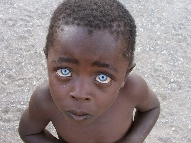 Beautyisintheeyesofme Waardenburg Syndrome