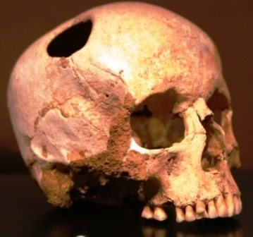 Los cirujanos Incas y las cirugías de cráneo trepanaciones