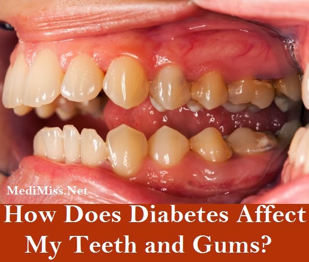 How Does Diabetes Affect My Teeth and Gums? SkinnyZine