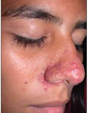 Natural Ways To Get Rid Of Acne While Pregnant Natural Ways To Get Rid Of Acne While Pregnant