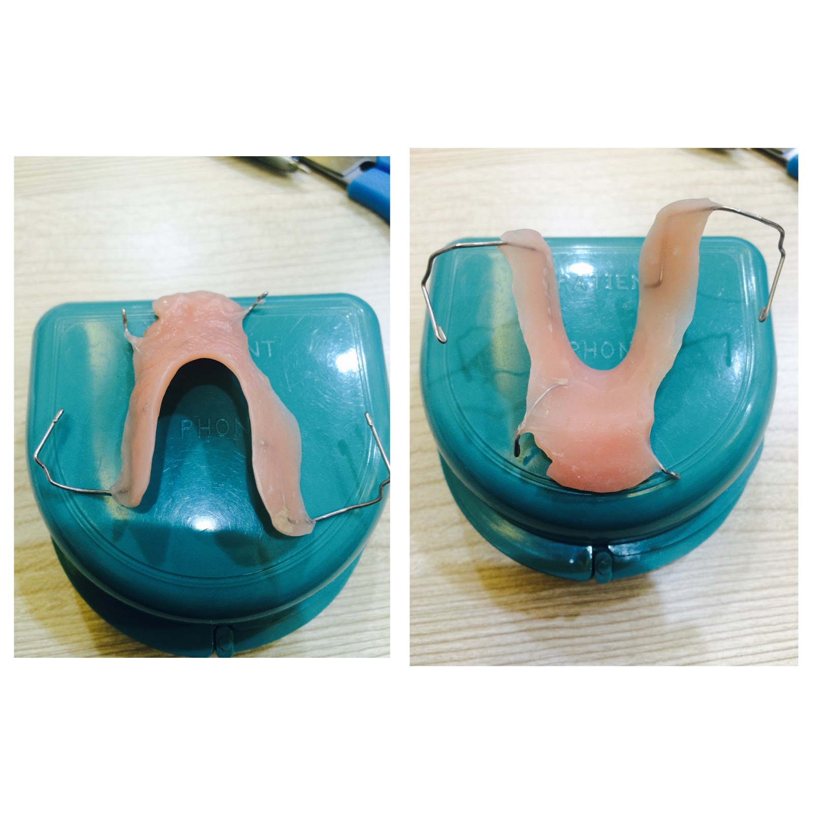 Braces Smile Removable Bite Plate