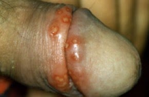Penyakit HerpesPada Laki-Laki