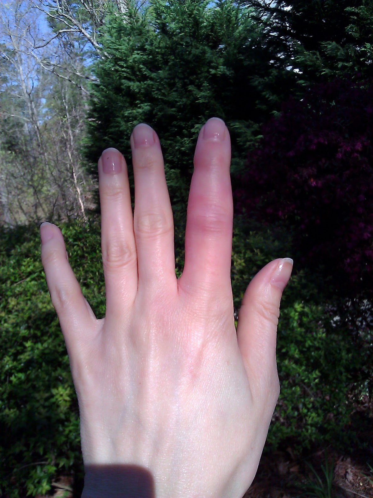 Saddleback Caterpillar Bites