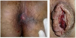 Obat Wasir Internal Obat Wasir Internal