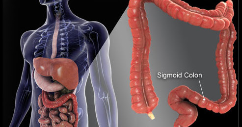 Obat Tradisional Kanker Usus ~ Obat Herbal Jantung Koroner