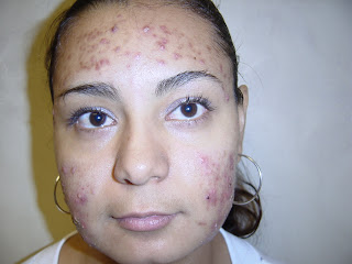 acne dermatologist