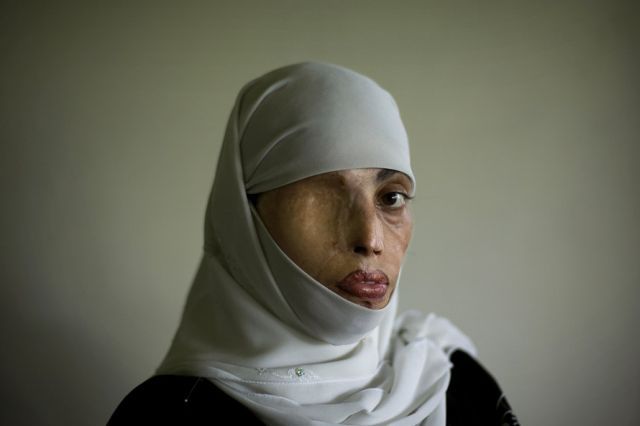 acid terrorism against women in pakistand-the big taboo horrible photos,pics,pictures