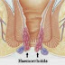 OBAT WASIR BERDARAH thumbnail