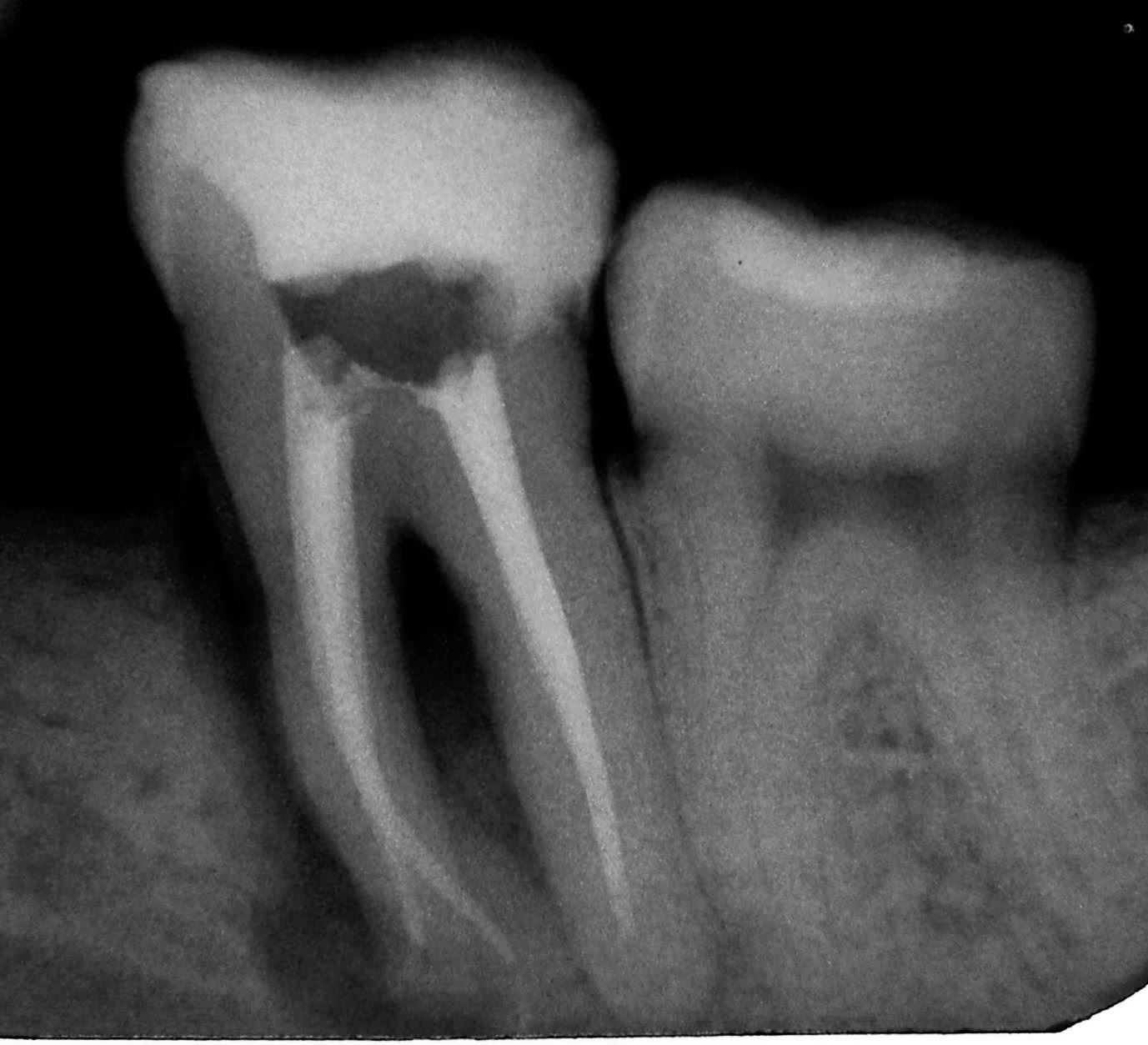Endo Perio Lesions Review Article at Luz Searles blog