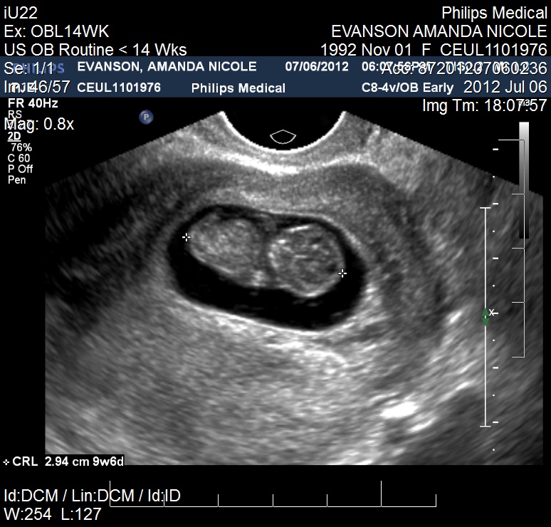 Week 9 Ultrasound