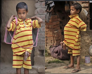 Fetus In Fetus, Parasitic Twin, Deepak Paswan