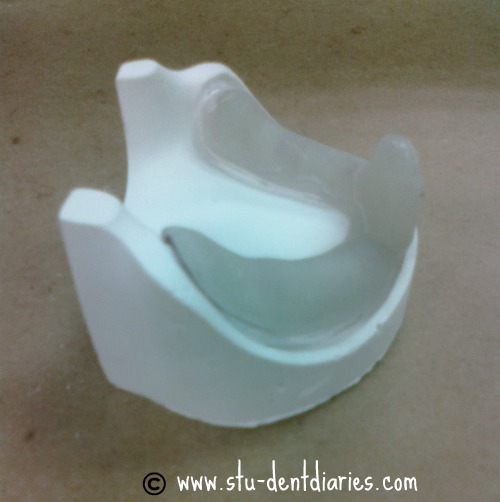 StuDENT Diaries Custom Tray, Record Base and Wax Rim