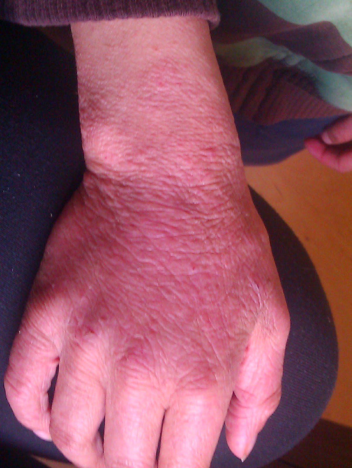 Steroids Make Eczema Worse April 2014