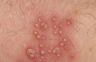 itching after sex in grown area itching after sex in grown area