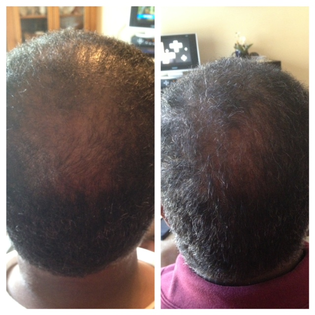 Balding Hair Loss Stubborn Hair That Won T Grow