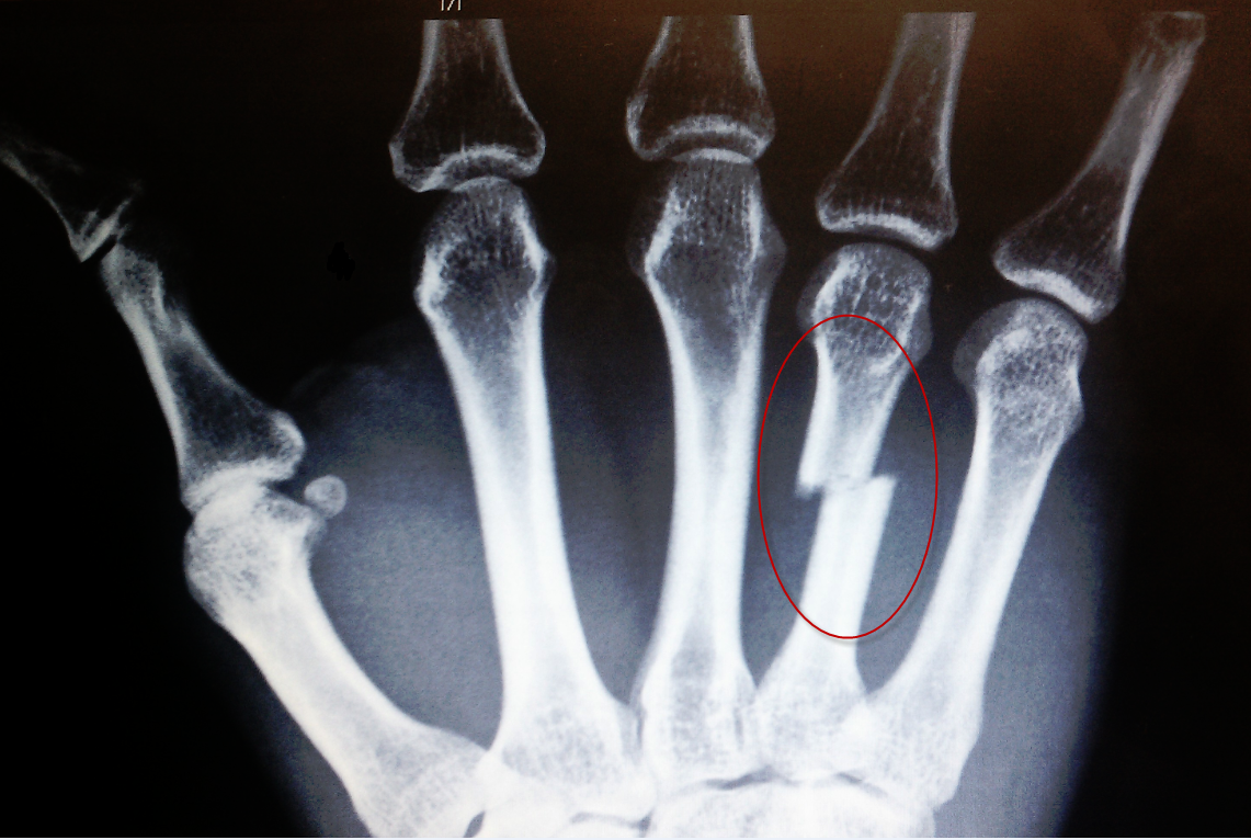 metacarpal fracture symptoms metacarpal fracture symptoms