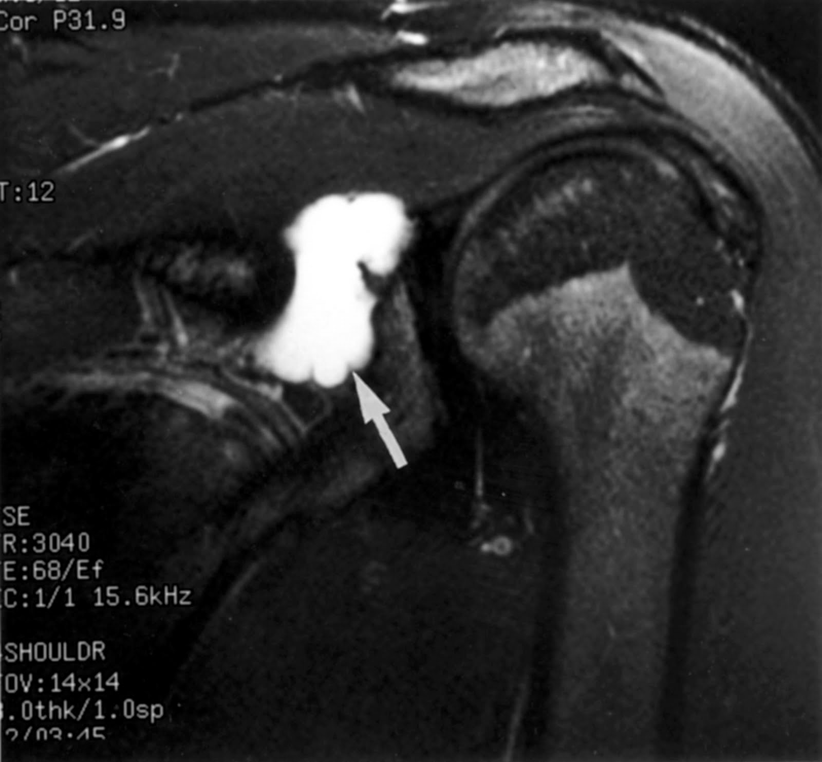 Rhoda's CT/MRI Procedures II Ganglion Cyst of the Shoulder