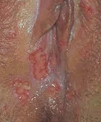 Penyakit Herpes Vagina Penyakit Herpes Vagina
