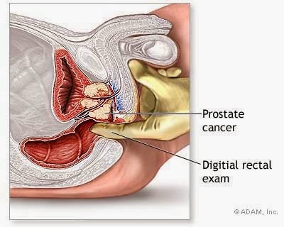 pengobatan ampuh kanker Prostat stadium 2, obat alami kanker Prostat stadium 1, obat alami kanker Prostat stadium 2