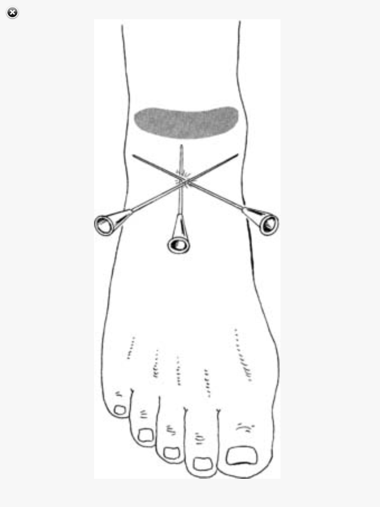 SRNA Daily Review REGIONAL ANESTHESIA BLOCKS